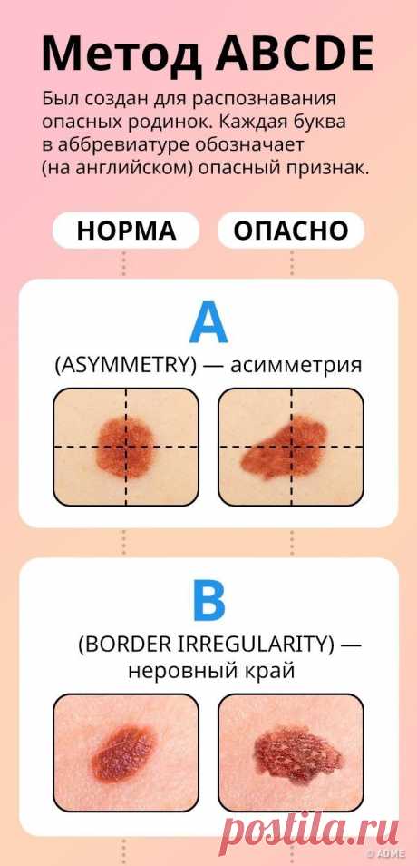 5 признаков того, что родинку нужно удалить как можно быстрее Многие слышали, что меланома — опасная опухоль, которая быстро дает метастазы и приводит к смерти в короткий срок. Около 25 % всех меланом развивается из обычных родинок.Публикуем инструкцию, как расп...