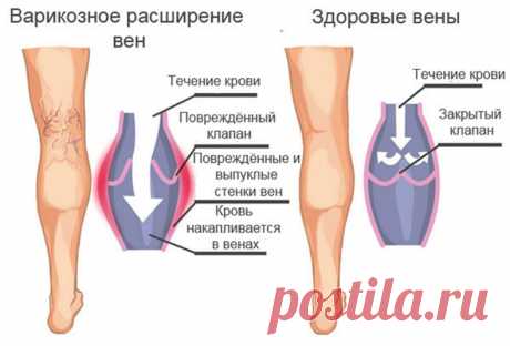 Полезные и вредные упражнения при варикозе Все причины расширения вен можно свести к двум: проблемы оттока крови из сосудов ног и слабая соединительная ткань в стенках кровеносных сосудов. Первая группа причин может быть устранена довольно просто, а вторая обусловлена генетическими особенностями и с ней можно только смириться.