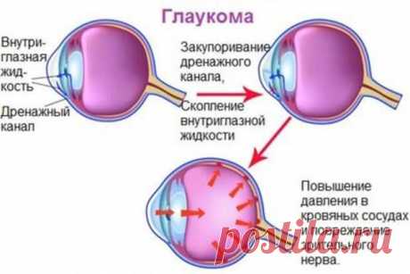 Глаукома: почему возникает и как предотвратить заболевание