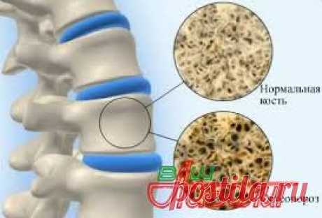 Причины симптомы и профилактика остеопороза » Ваш доктор Айболит
