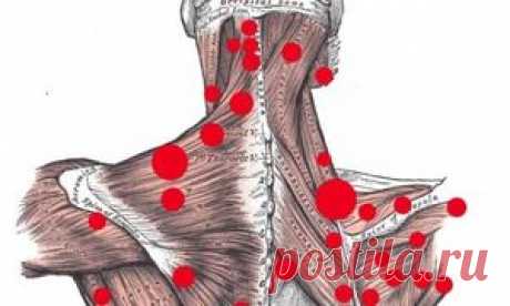 Триггерные точки: Как найти и как лечить