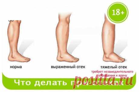 Что делать при отеках