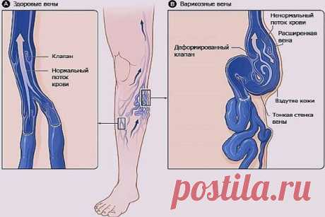 8 рецептов как избавиться от варикоза народными средствами - Жизнь - Здоровье - GlavPost.Com