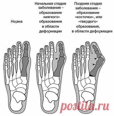 Как вылечить косточку на ноге.