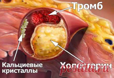 После такой чистки сосудов проходит гипертония и ещё 9 якобы «неизлечимых» заболеваний