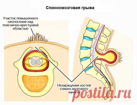 Спинномозговая грыжа: классификация, причины, лечение
В организме человека могут развиваться разные заболевания, одно из них – спинномозговая грыжа. Формируется во время беременности. Чаще всего проявляется в поясничном отделе, реже в других местах. Патология представляет собой, несрастание нескольких позвонков, с выпадением спинного мозга и нервных окончаний.