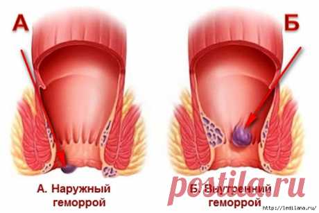 Лучшие рецепты лечения геморроя народными средствами