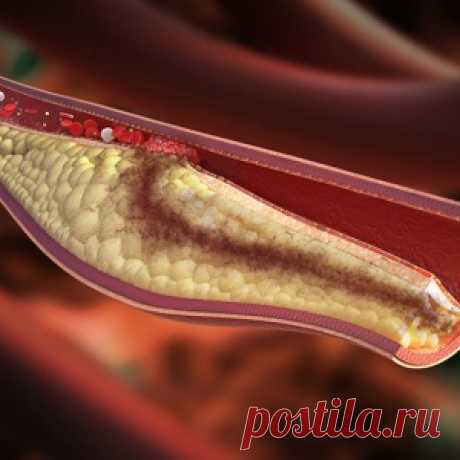 Признаки высокого уровня холестерина в крови — не пропустите!