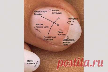 О чем расскажут ваши ногти – определяем болезни по ногтям