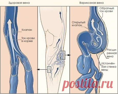 Лечение варикозного расширения вен.