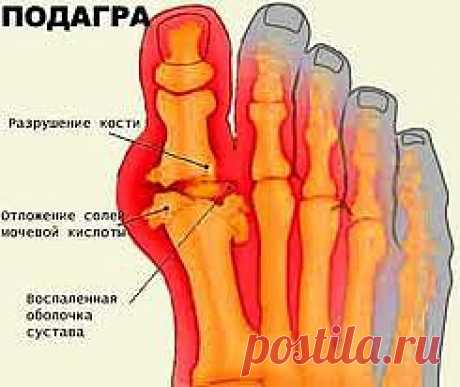 Подагра - симптомы и лечение