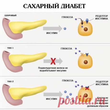 Сахарный диабет - какое эффективное лечение?