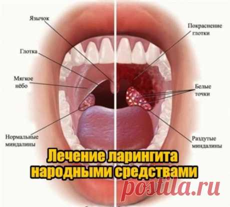 Лечим ларингит народными средствами В дополнение к назначенным врачом лекарственным препаратам полезно использовать народные средства от ларингита. Одно из них — полоскания горла содовым раствором, который готовится из расчета 1 чайная ложка соды на стакан теплой воды...