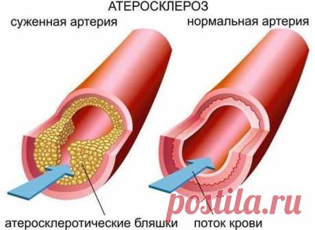 Другой взгляд на причины возникновения атеросклероза. Ч.2 | Здоровье от природы | Яндекс Дзен