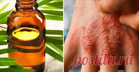 Масло чайного дерева для лечения любого состояния кожи (шрамы, бородавки и т/д)