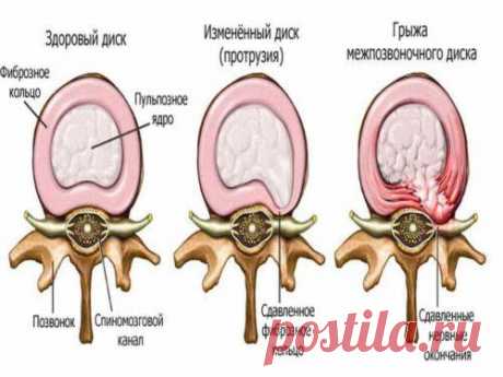 Как вылечить грыжу шейного отдела позвоночника — vseOspine