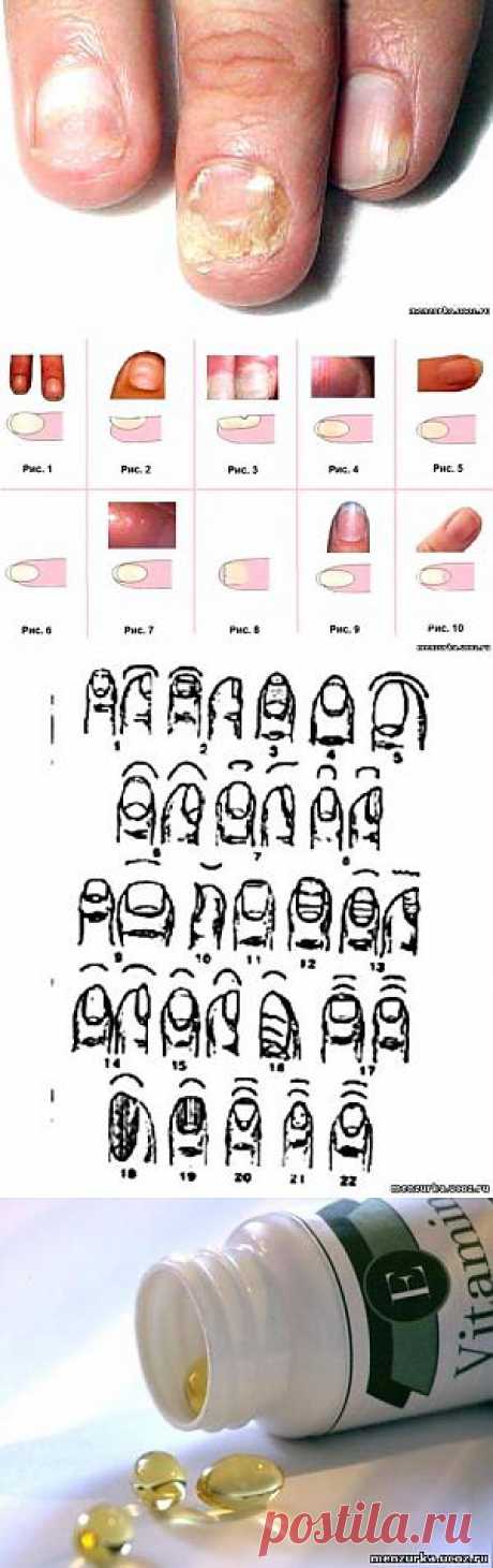 Диагностика болезней по ногтям - Восточная Медицина  - Каталог статей - Мензурка