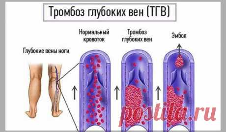 Тромбоз глубоких вен — тихий убийца 

Тромбоз глубоких вен — тихий убийца! Эти 5 ранних симптомов предупреждают об угрозе! Будьте внимательны к любым симптомам тромбоза и не игнорируйте их. У вас есть только одна жизнь!

Тромбоз глубоки…