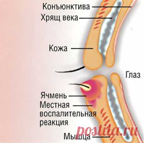 Ячмень на глазу, лечение, симптомы, причины. Как лечить внутренний ячмень века.