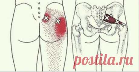 2 трюка, которые разблокируют седалищный нерв и облегчат боль в течение нескольких минут ...