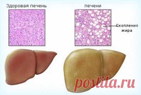 Стеатоз печени — причины и лечение - Я ЗДОРОВ! - медиаплатформа МирТесен