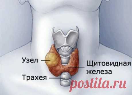 Смешайте по одному стакану молотой гречневой крупы, пропущенных через мясорубку грецких орехов и меда в эмалированной (абсолютно чистой) посуде и переложите в стеклянную банку. Один раз в неделю за целый день съешьте этот состав, не принимая больше никакой пищи, кроме воды. Сделайте так шесть раз, т. е. шесть недель. Затем через месяц повторите лечение. Уже после первого курса зоб уменьшится, а после второго болезнь оставит вас. 

Проверьтесь на УЗИ: щитовидка будет в норме.