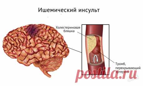 Причины и профилактика инсульта головного мозга. Как не допустить развития инсульта головного мозга