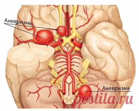Аневризма - бомба замедленного действия. Коварство и симптомы аневризы сосудов головного мозга. | Ваш семейный доктор | Яндекс Дзен
