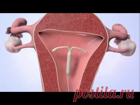 Patient Education Video: Intrauterine Device (IUD)