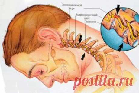 Простое избавление от остеохондроза: как муж вылечился - interesno.win