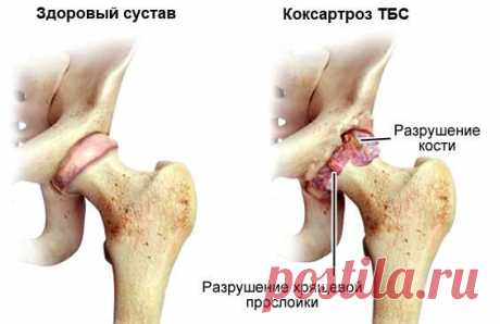 Артроз тазобедренного сустава 2 степени: симптомы и лечение