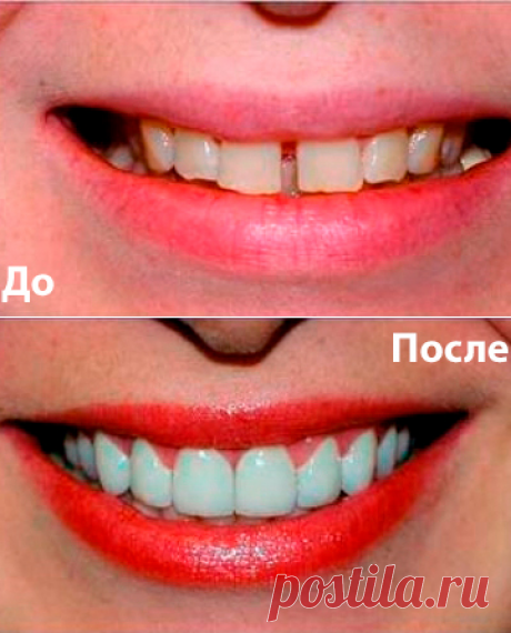 Perfect Smile Veneers