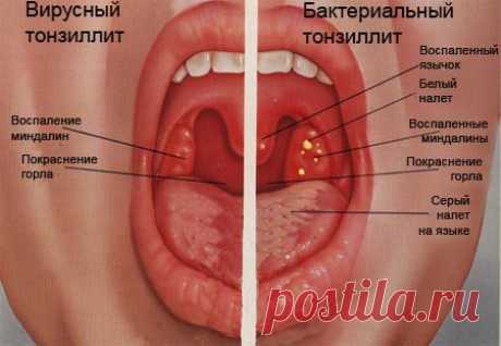 Чистим миндалины и не болеем