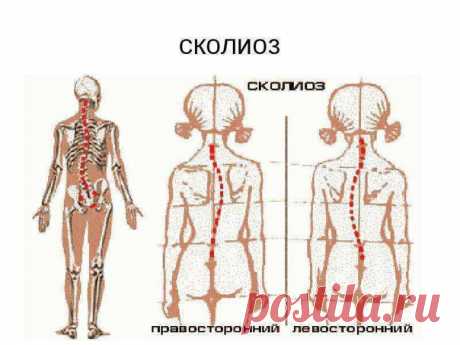Сколиоз 

Всем доводилось встречать взрослых людей с видимыми внешними признаками сколиоза: с выраженной асимметричностью спины, когда лопатки находятся не на одной линии, а одна очень сильно выделяется. Эти люди прячут свою искривленную спину под просторной одеждой, девушки прикрывают спину распущенными волосами. Но прикрыть можно только внешнее проявление сколиоза. От влияния на здоровье внутренних органов нужно спасаться задолго до возникновения таких видимых деформаций...