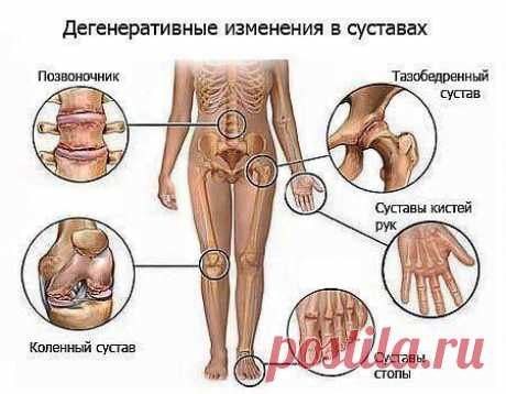 Почему хрустят суставы? Чем можно им помочь?.