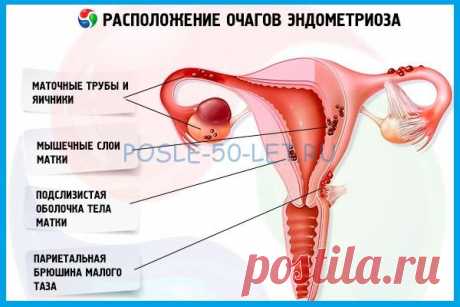 Лечение эндометриоза у женщин после 50 - 55 лет