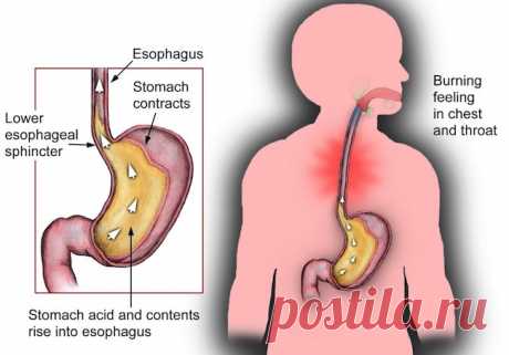 Естественные способы, чтобы управлять кислотного Рефлюкса Жгучая боль в груди, что кислый вкус резервное копирование в рот . . . кислотный рефлюкс чувствуется и на вкус ужасный, особенно если вы часто испытываете его.
