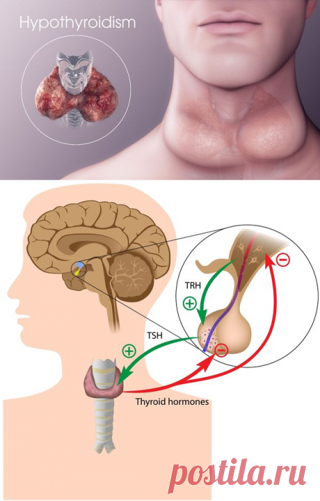 БОЛЕЗНИ ЩИТОВИДНОЙ ЖЕЛЕЗЫ--ГИПОТЕРИОЗ: причины, симптомы и лечение в статье терапевта Курашова О. Н.