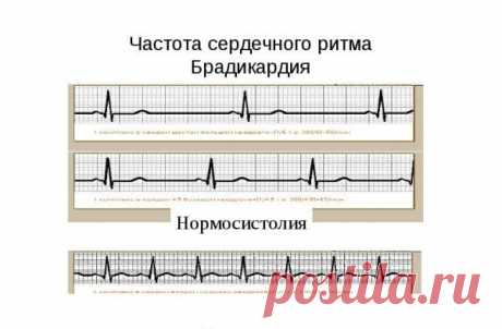 Брадикардия сердца – лечение народными средствами и правильное питание во время болезни