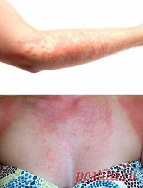 Аллергия на солнце - причины, симптомы, лечение, фото, мази и кремы от аллергии на солнце