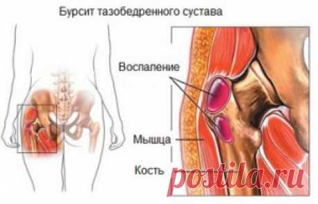 Бурсит тазобедренного сустава: симптомы и лечение в домашних условиях.