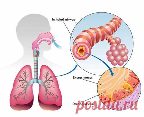 Как избавиться от самого застарелого кашля, не поддающегося