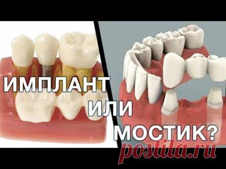 Имплант или зубной мостик. Что лучше выбрать? Имплантация зубов. Мост зубной.