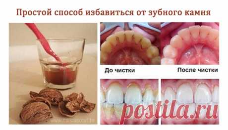 Как избавиться от зубного камня без посещения стоматолога? К счастью, есть простое народное средство, которое поможет справиться с зубным камнем и сохранит зубы здоровыми.