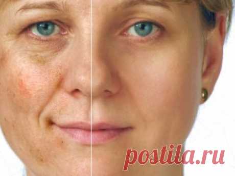 Народные средства от пигментных пятен на лице: как избавиться, убрать и осветлить пятна
