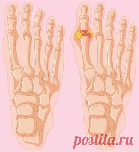 Всё, что нужно знать о подагре / Будьте здоровы