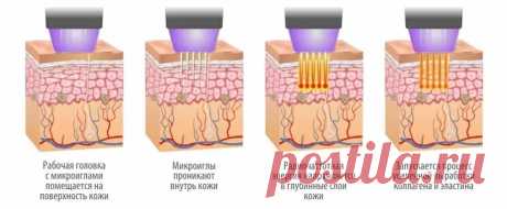 Игольчатый рф лифтинг обзор аппаратов Morpheus, Scarlet, Infini, Ellisys - Косметология Игольчатый рф лифтинг является достойной альтернативой хирургической подтяжке лица. В сравнении с пластикой при проведении радиочастотной манипуляции отсутствует дискомфорт и болевые ощущения. Кроме того, очевидный эффект омоложения появляется сразу после проведения первого сеанса процедуры. В современной косметологии используются различные качественные и функциональные аппараты. В этой...