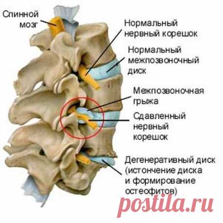 МЕЖПОЗВОНОЧНАЯ ГРЫЖА - ПРИЧИНЫ, СИМПТОМЫ И ЛЕЧЕНИЕ