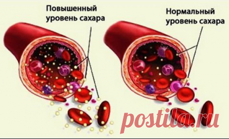 5 ранних признаков высокого сахара в крови (и как его реверсировать) | будь здоров! | Яндекс Дзен