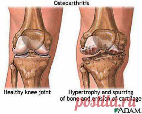 Артрит.Артроз.Как отличить? | Знахаръ